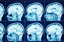 Вчені виявили серйозну небезпеку Covid-19 для мозку