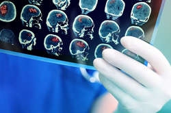 За словами медиків, з'являється все більше доказів того, що інфекція Covid-19 може викликати згортання крові незвичайними способами, і інсульт може бути очікуваним наслідком цього