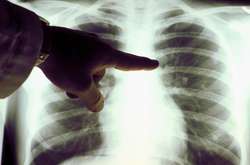 На Львівщині від коронавірусу померло ще дві людини