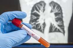 Количество зараженных коронавирусом в Украине превысило 20 тысяч