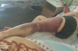  Працівники поліції побили чоловіка під час обшуку 