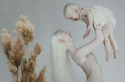 13 червня відзначається Міжнародний день поширення інформації про альбінізм