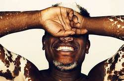 25 червня відзначається Всесвітній день вітіліго - це рідкісне порушення пігментації шкіри, яке ще не до кінця вивчене наукою