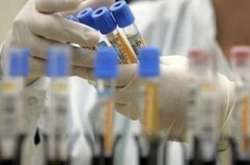 Вчені назвали спосіб спрогнозувати важкий перебіг коронавірусу