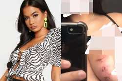 Британка получила ожоги на груди от одежды известного бренда (фото)