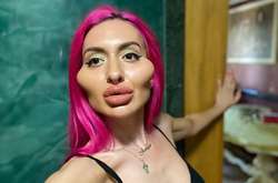 Украинка, накачавшая огромные скулы, стала звездой британского телешоу (видео)