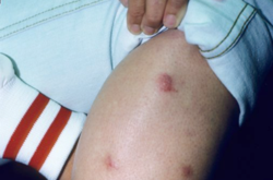 Блохи атакували мешканців багатоквартирного будинку у російському Хабаровську