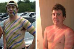 Фото бедолаг, которые не воспринимали солнце всерьез и поплатились за это