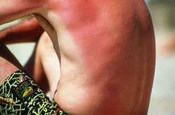 Как эффективно избавиться от солнечных ожогов с помощью подручных средств