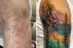 Как скрывающие шрамы татуировки помогают вернуть уверенность в себе