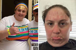 Эти люди недооценили солнце и получили коварный загар: курьезные фото