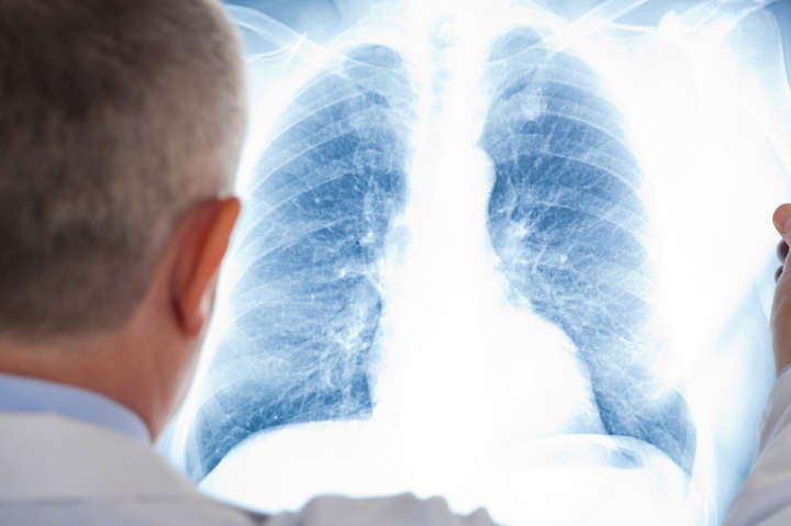 Вчені виявили, що Covid-19 призводить до перфорації легень