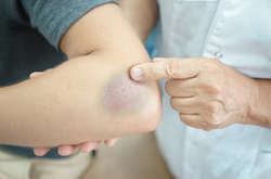 Лікарі назвали перші симптоми раку крові