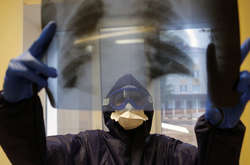 Вчені виявили ще один ранній симптом коронавірусу