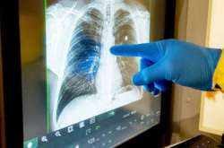 Пневмонія може бути спровокована вірусною інфекцією, в тому числі і коронавірусом