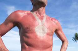 Как люди создают опасные татуировки с помощью сильного загара: курьезные фото