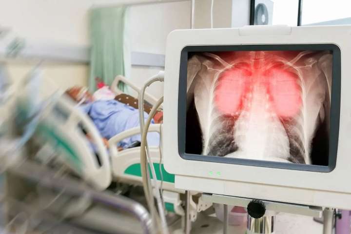 Львівські лікарі показали, як виглядають легені тяжкохворих на Сovid-19