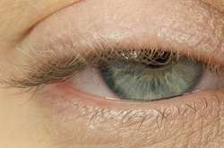 Слизові виділення або різь в очах – характерні ознаки бактеріальних інфекцій