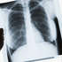 Вчені розкрили вплив коронавірусу на легені