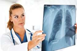 Ученые раскрыли неожиданный признак рака легких