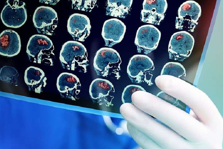 Вчені пояснили проблеми з мозком у хворих на Covid-19
