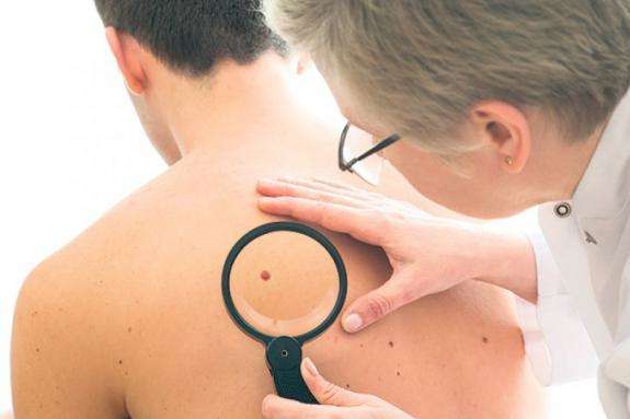 Медики назвали перші ознаки раку шкіри