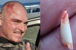 В Африке укусила мужчину и сломала зуб