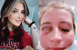 Американка осталась с изуродованной, когда чихуа-хуа укусил ее за веко во время наращивания ресниц