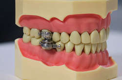 «Замок» для щелепи: вчені винайшли пристрій для схуднення