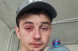  Львів'янин дістав контузію правого очного яблука, пошкодження рогівки ока і крововилив 