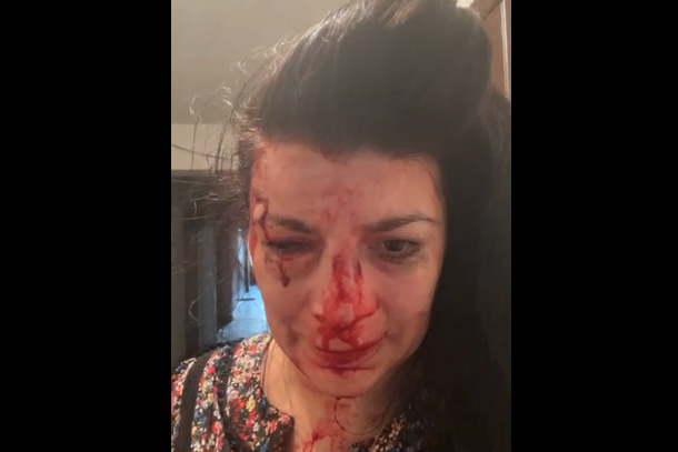 Зламаний ніс і вибиті зуби: у Дніпрі жорстоко побили правозахисницю (відео)