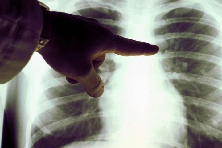 Вчені пояснили розвиток раку легенів у некурців