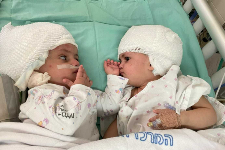 Ізраїльські лікарі провели унікальну операцію з розділення сіамських близнючок