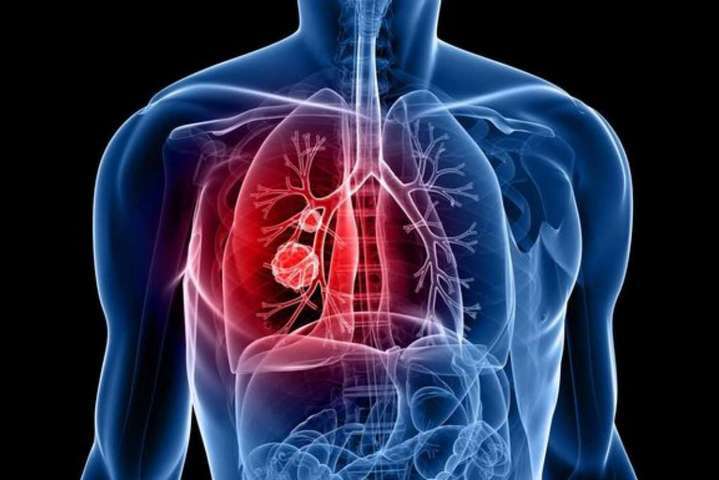 У серпні у більш ніж півтори тисячі українців виявили туберкульоз