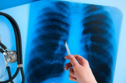 В августе у более полторы тысячи украинцев обнаружили туберкулез 