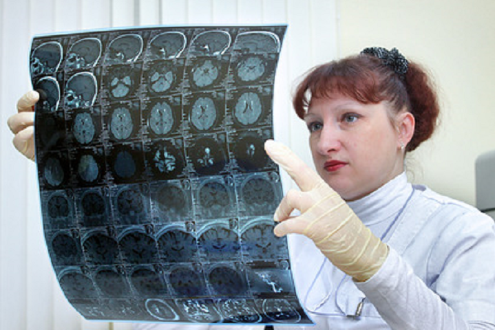 Вчені виявили причину прогресування хвороби Альцгеймера