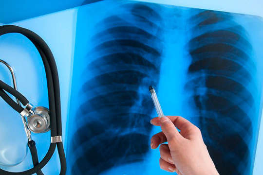  В Україні склалася тривожна ситуація з туберкульозом через Covid-19