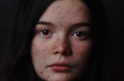 Дерматолог рассказала, как правильно избавляться от прыщей