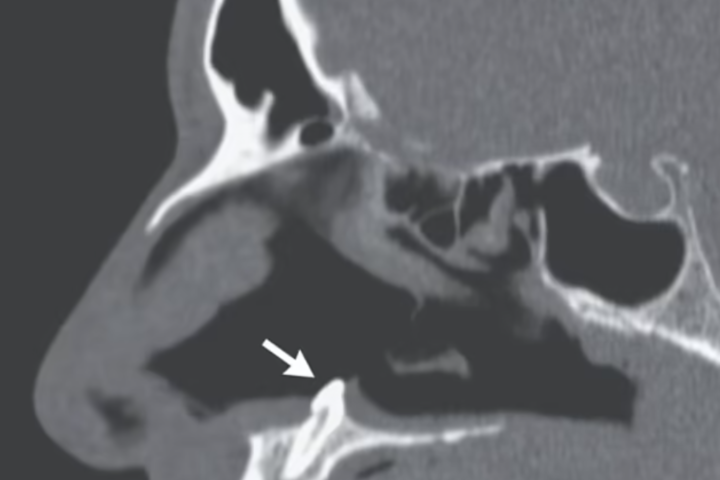 В американця виріс зуб у носі: йому зробили операцію (фото)