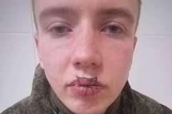 У Росії 19-річний солдат-строковик зашив собі рота
