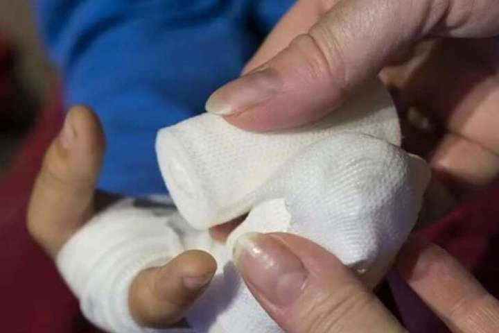 Жертва феєрверків: у Дніпрі чоловіку відірвало палець петардою