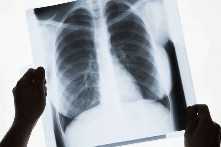 Вчені оцінили вплив «Омікрон»-штаму на легені