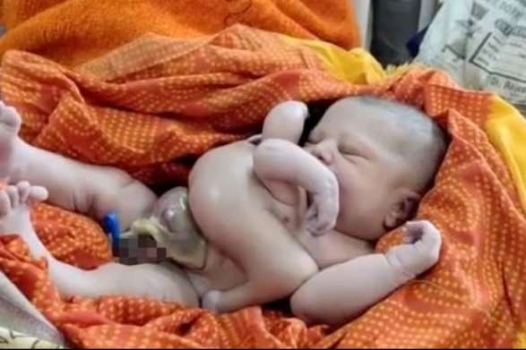В Індії народилася дитина з чотирма руками та ногами (фото, відео)
