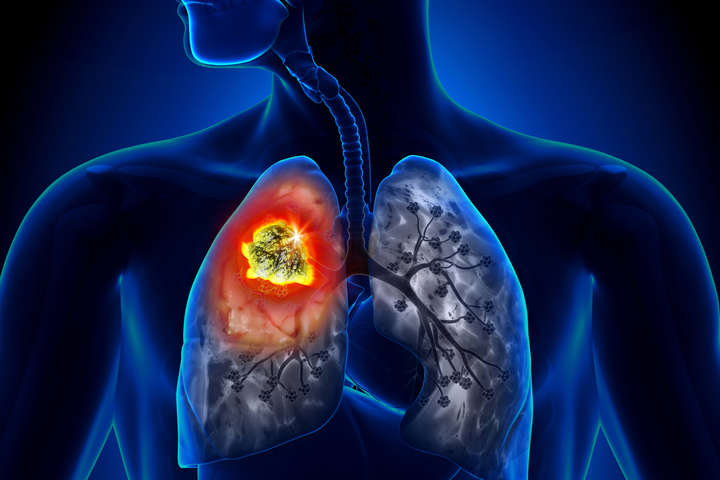 Британські медики назвали «шкірні» симптоми раку легенів