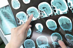 Медики попередили про ризик розвитку хвороби Альцгеймера після Covid-19