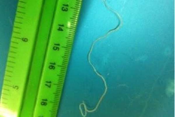 У Львові лікарі дістали з ока дитини паразита розміром 10 см (фото)
