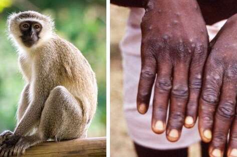 Висипання на тілі &ndash; основні симптоми віспи мавп - У Британії зафіксовано зараження рідкісною хворобою
