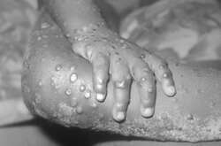 Мавпяча віспа продовжує ширитися світом