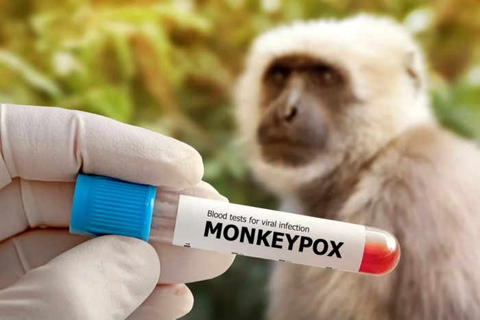 США оголосили надзвичайну ситуацію через поширення мавпячої віспи