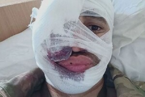 Известный актер, получивший ранение на передовой, показал лицо после операции
